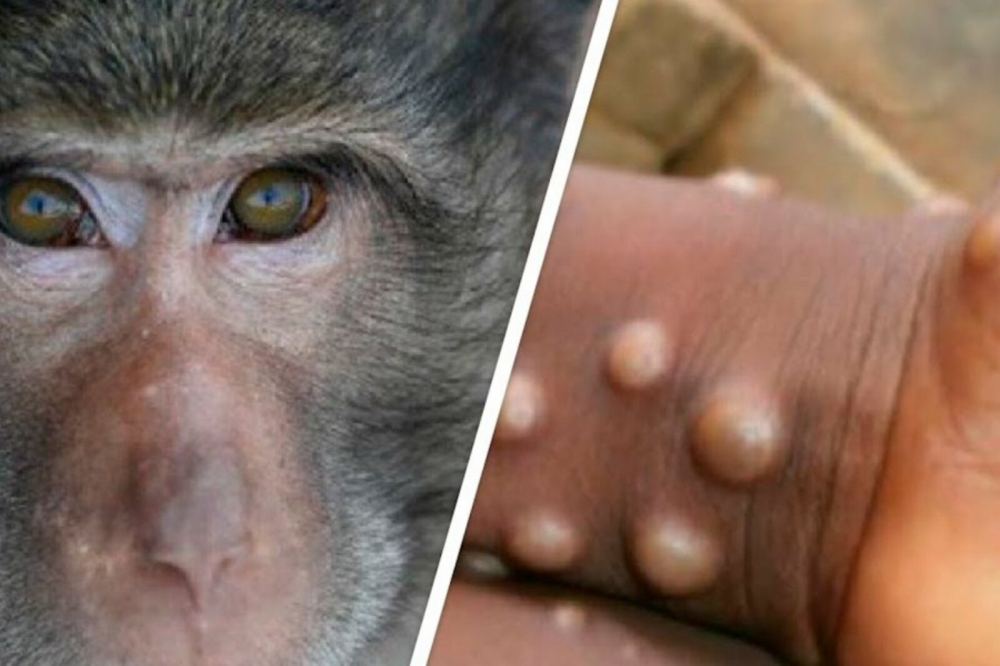 В Японии умер первый пациент с оспой обезьян